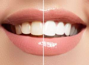 Teeth Whitening Courses: Learn Teeth Whitening